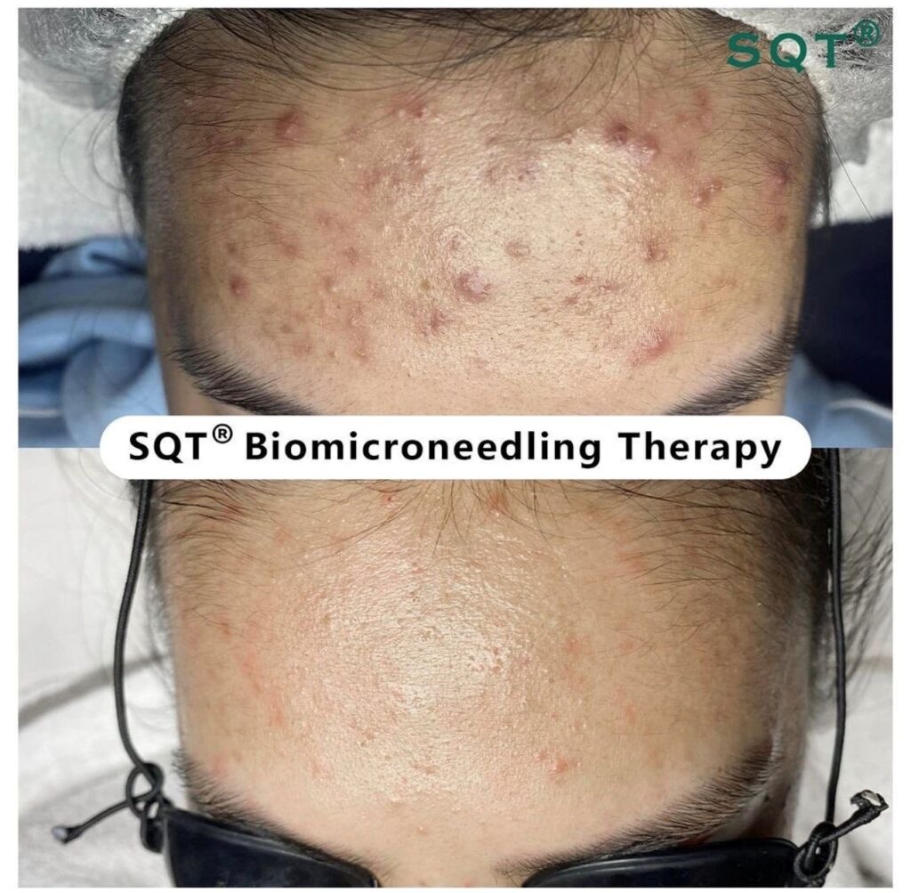 SQT Bio Microneedling in Cape Town: The Natural Skin Reset Your Skin Has Been Waiting For