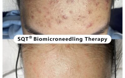 SQT Bio Microneedling in Cape Town: The Natural Skin Reset Your Skin Has Been Waiting For